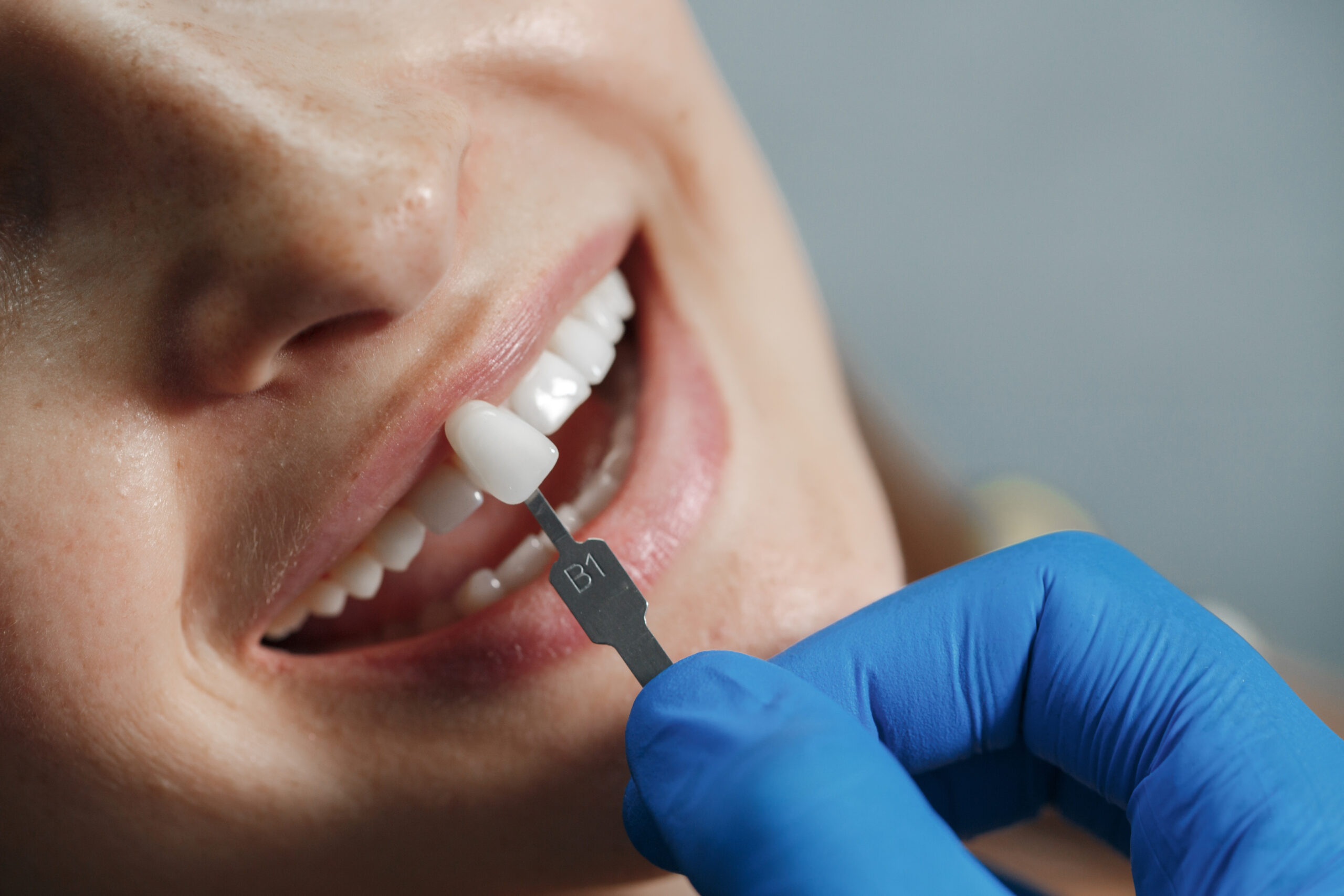 Imagem mostrando um paciente sorrindo enquanto o dentista insere o implante dentário em sua boca.