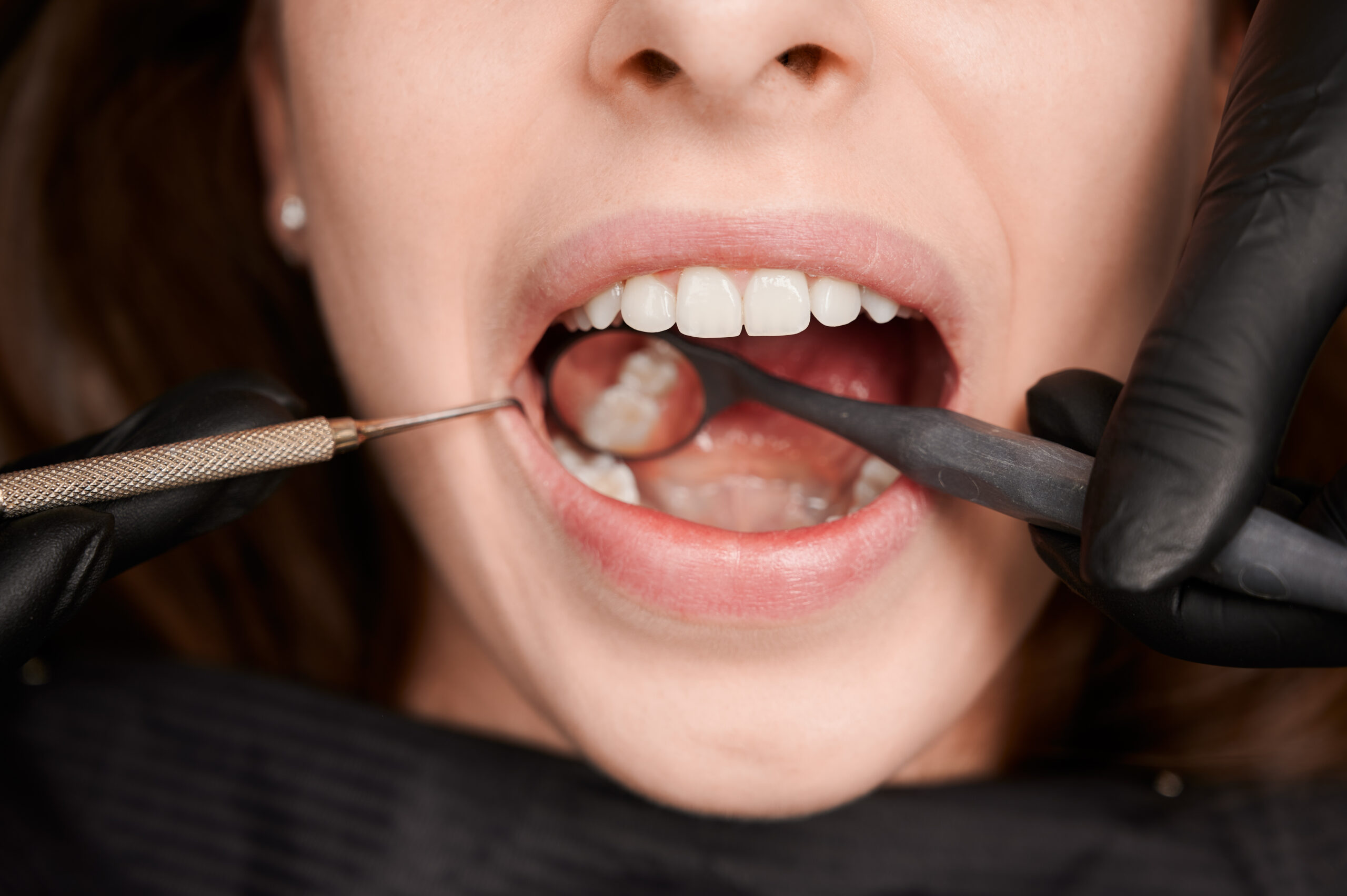 Paciente fazendo uma avaliação com o dentista para fazer a extração de siso.