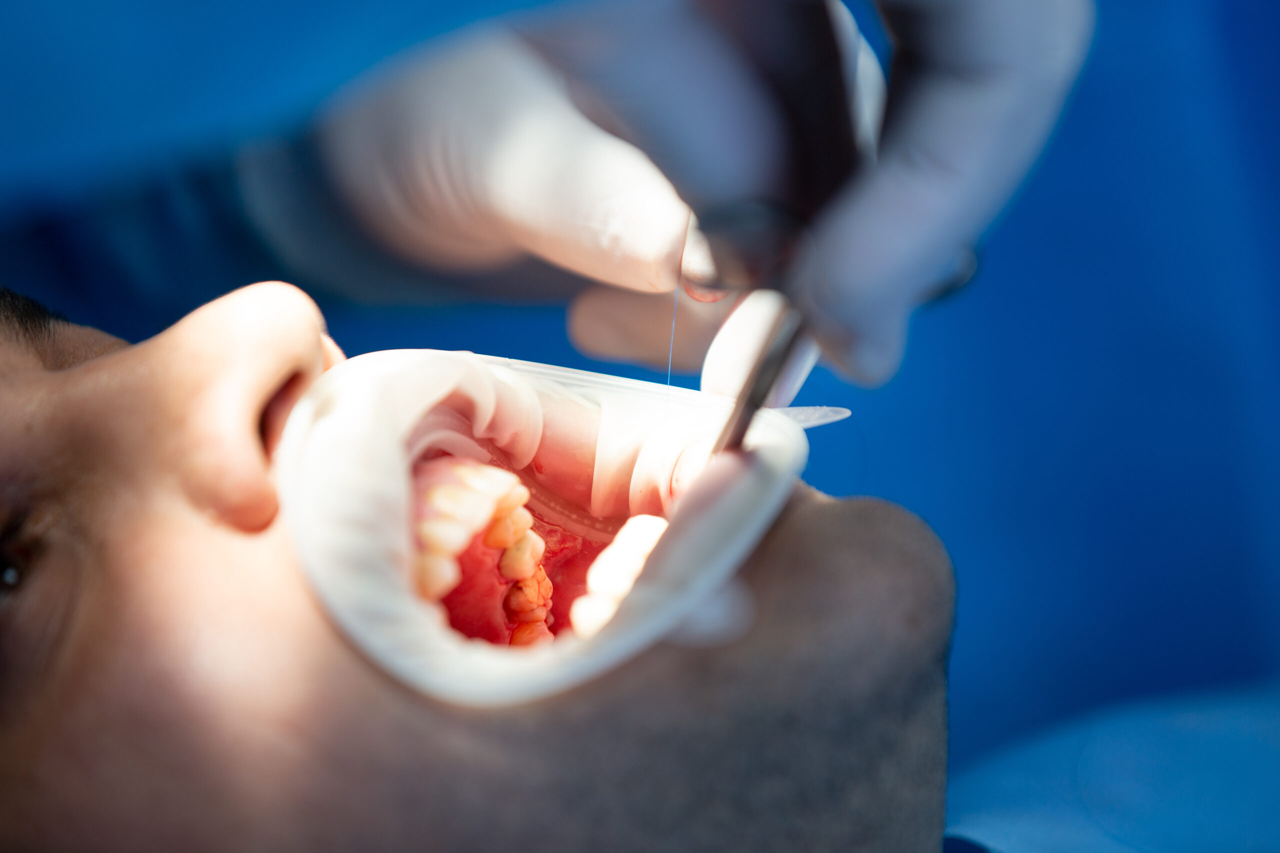 Paciente fazendo uma extração de dentes.