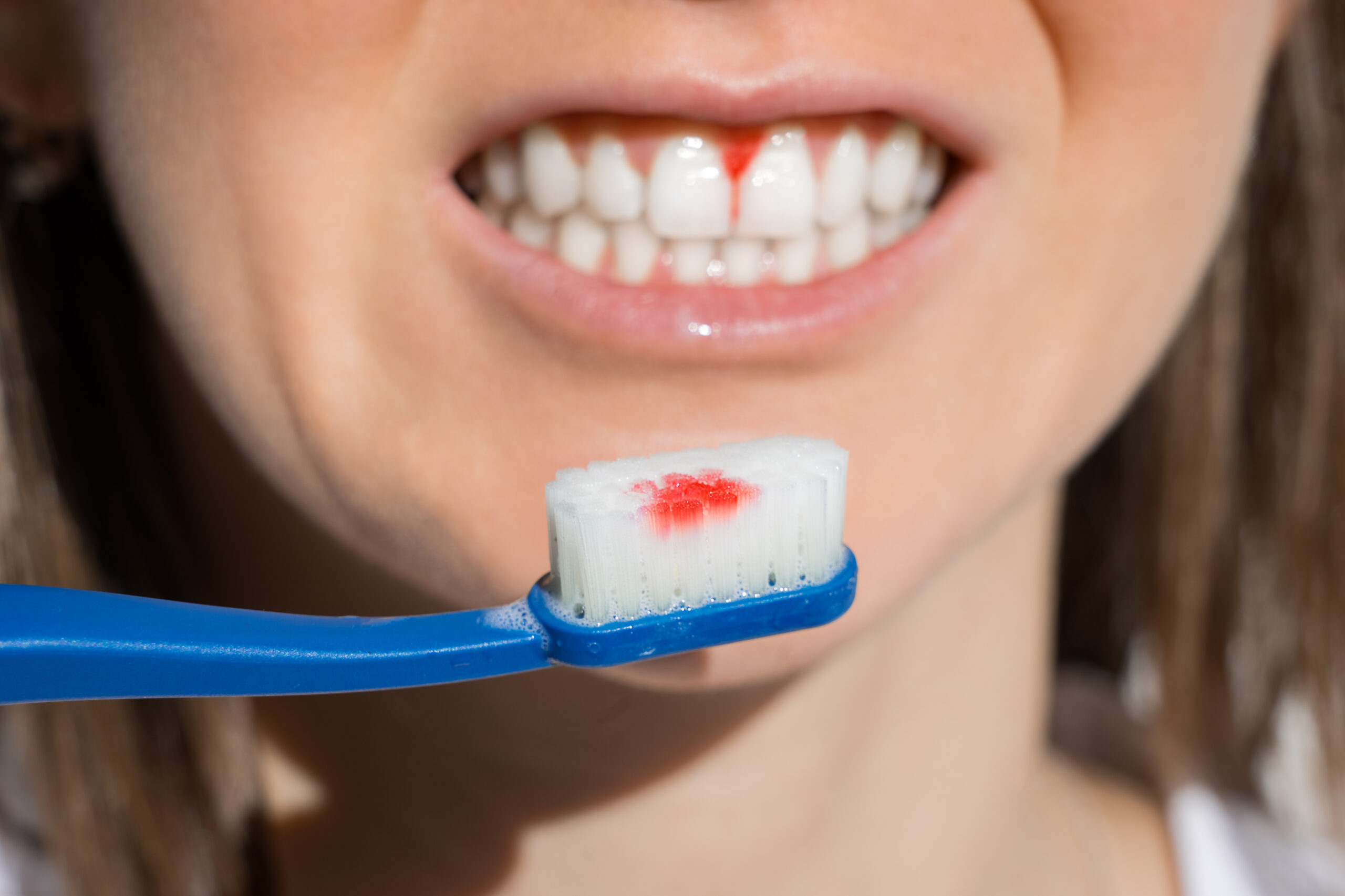 Mulher com a gengiva sangrando mostrando sua escova de dentes suja de sangue.